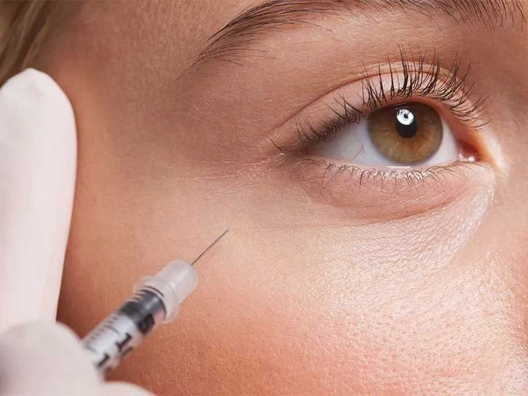 تزریق فیلر زیر چشم