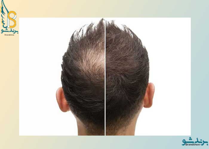 میکروپیگمنتیشن 