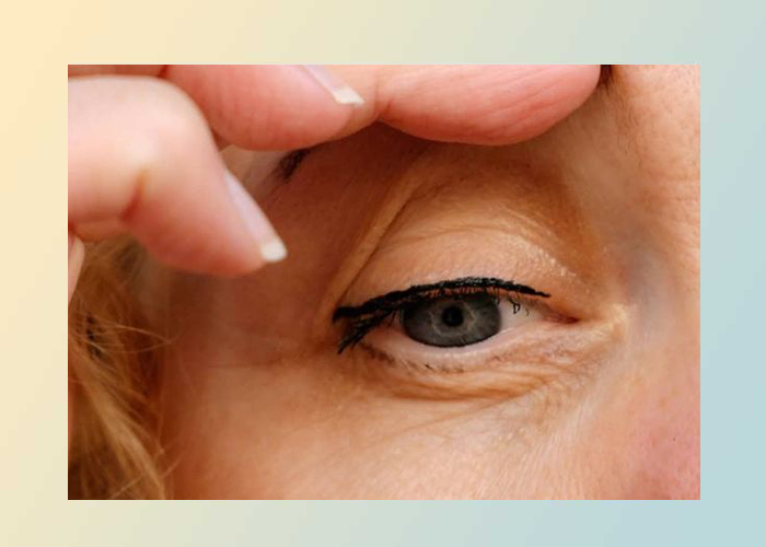 تفاوت افتادگی پلک واقعی و شبه‌افتادگی در تشخیص بلفاروپلاستی