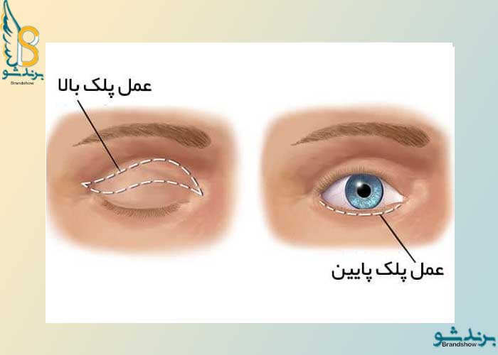جراحی پلک یا بلفاروپلاستی چیست