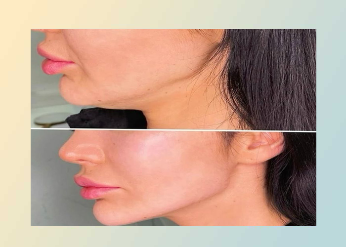 تأثیر جنیوپلاستی بر تعادل نیمرخ صورت